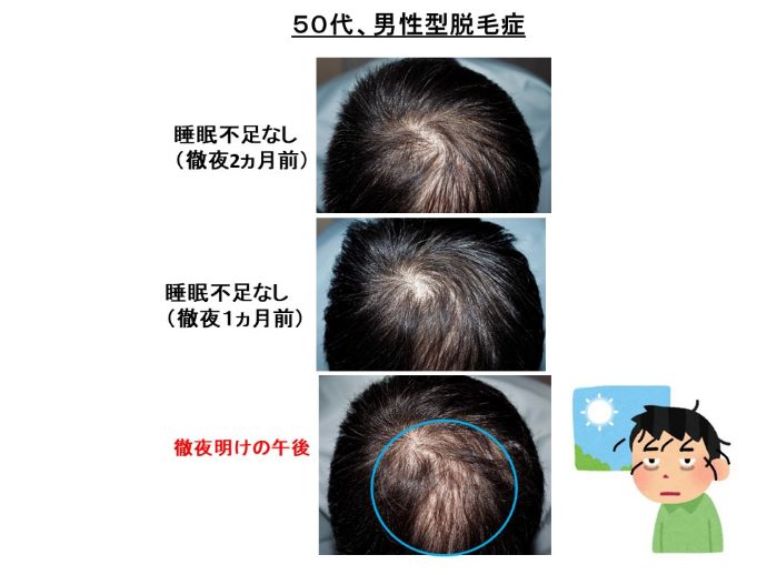 円形脱毛症　病院